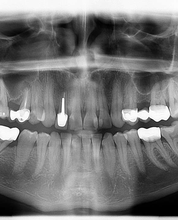 Snimak zubi kod pacijenta Dental Centar Pollak