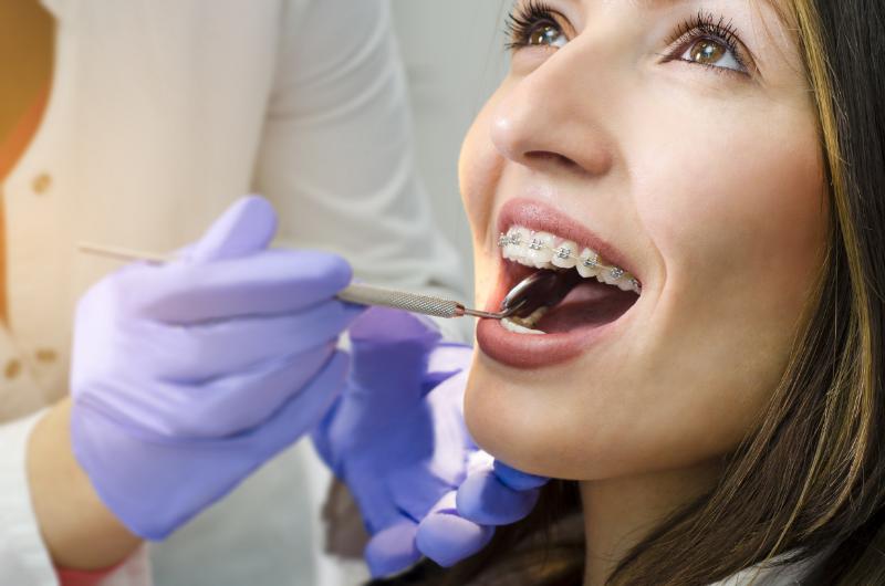 Fiksni-aparatic-dental -pollak