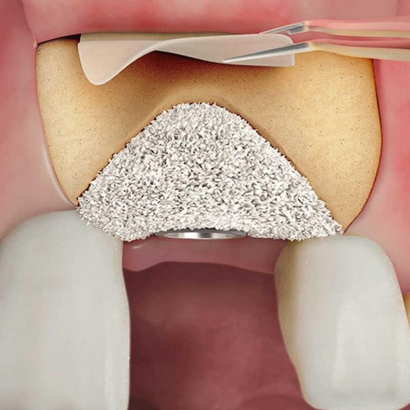 Augumentacija – Dental Pollak Osijek Augumentacija - Dental Pollak Osijek